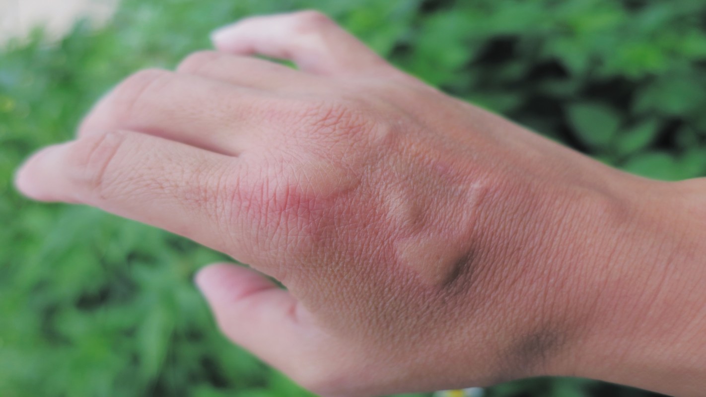 A hand with visible swelling and redness against a blurred green background.