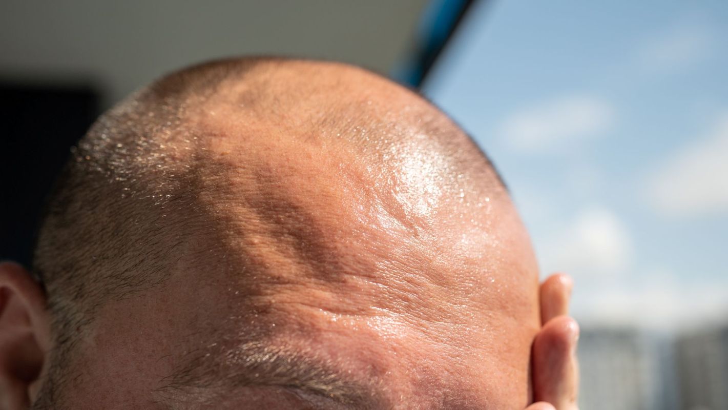 A person's scalp is visible with a shiny texture under bright sunlight.