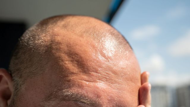 A person's scalp is visible with a shiny texture under bright sunlight.