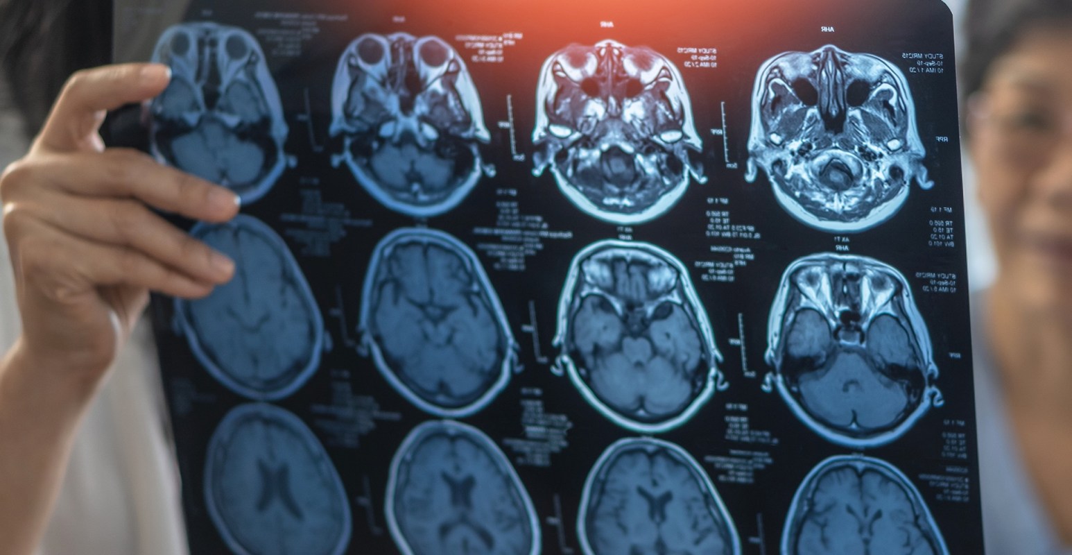 A person holds an MRI scan showing images of the brain.
