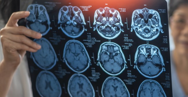 A person holds an MRI scan showing images of the brain.