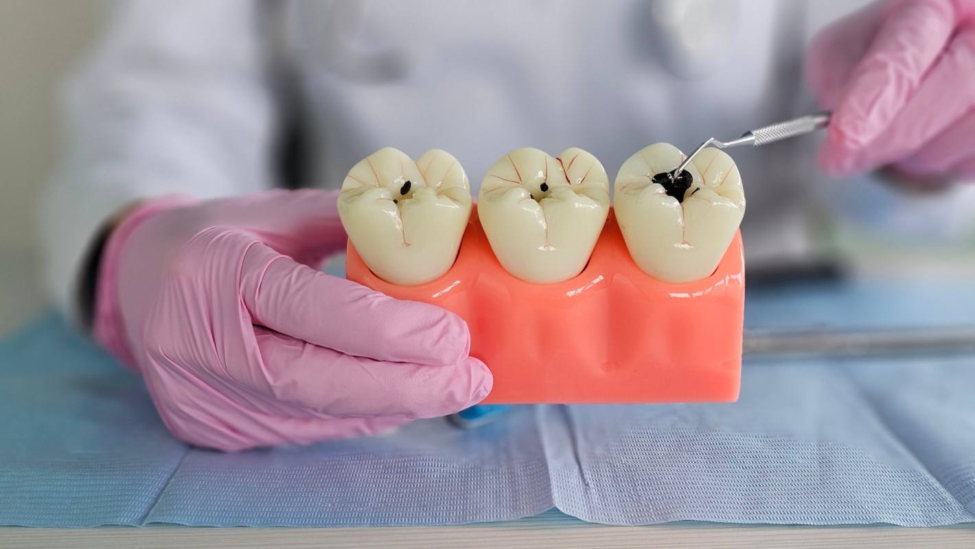 A person holds a dental model with three teeth, one showing a cavity, next to dental tools on a blue surface.