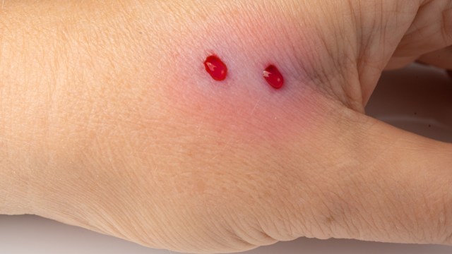 A hand with two drops of blood on the skin, surrounded by a slight redness.