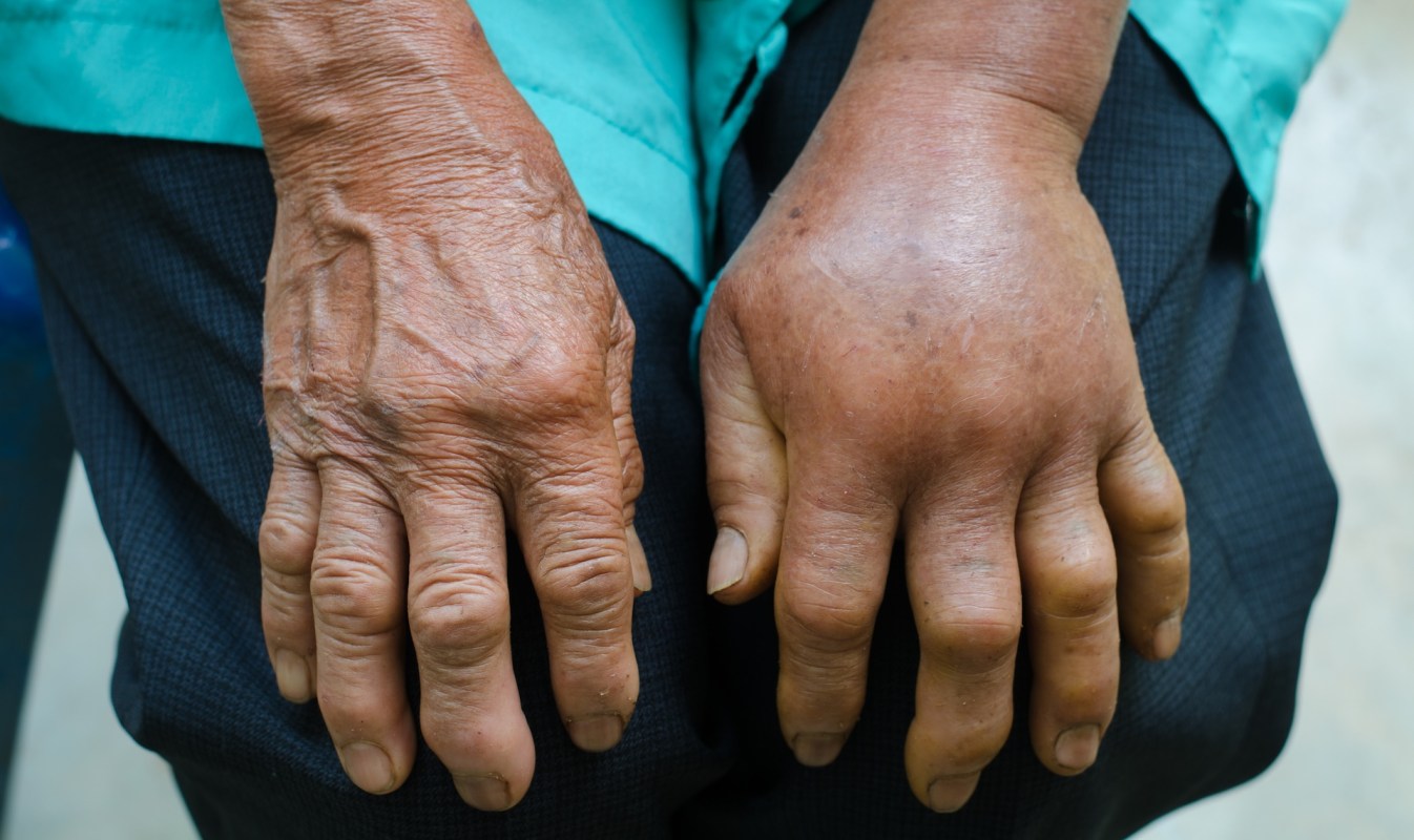Two hands resting on a lap, one visibly aged and the other swollen after a snake bite.