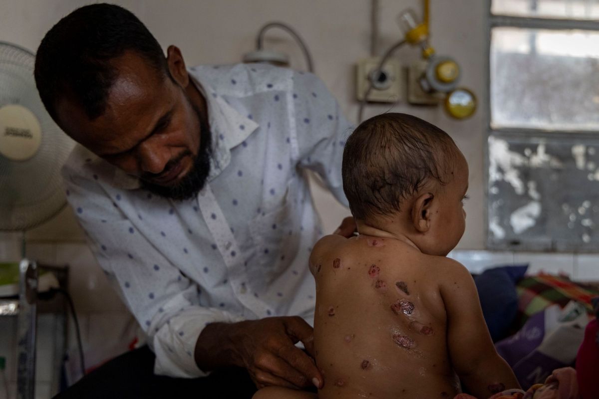 A child with measles is treated at the Infectious Diseases Hospital in Mohakhali.