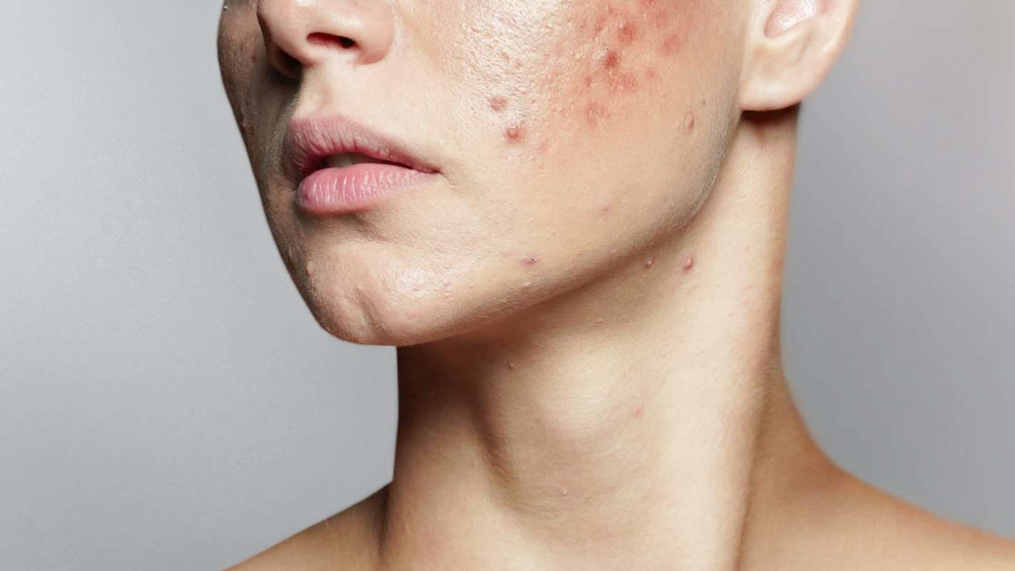 A person with acne.