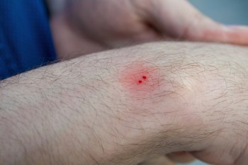 A close-up of a skin area on a forearm showing two small red spots.